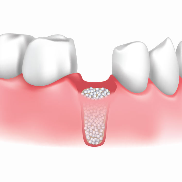 Bone Grafting - Dental Services