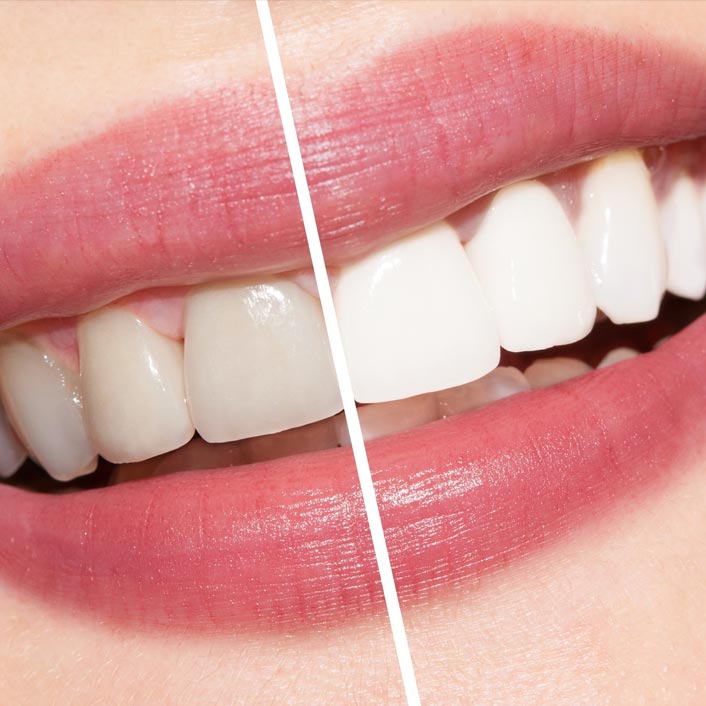 Zoom! Whitening - Dental Services